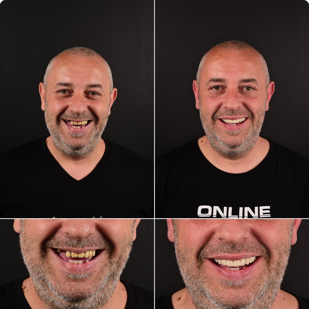 Caz 01, reabilitare orală pe implanturi la Radent Estetique Arad, înainte și după