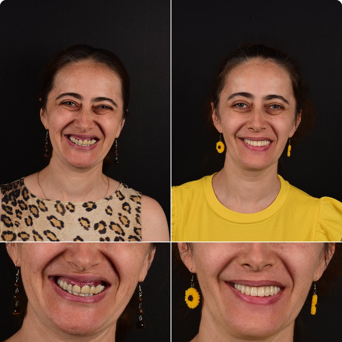 Caz 03, reabilitare orală pe implanturi la Radent Estetique Arad, înainte și după