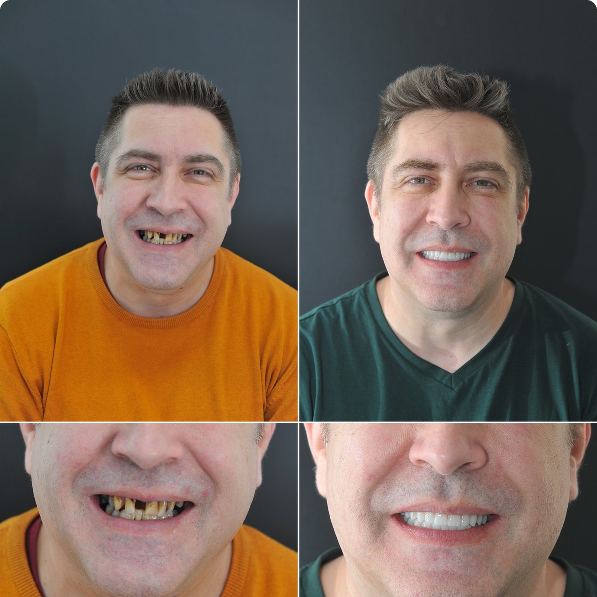 Caz 07, reabilitare orală pe implanturi la Radent Estetique Arad, înainte și după
