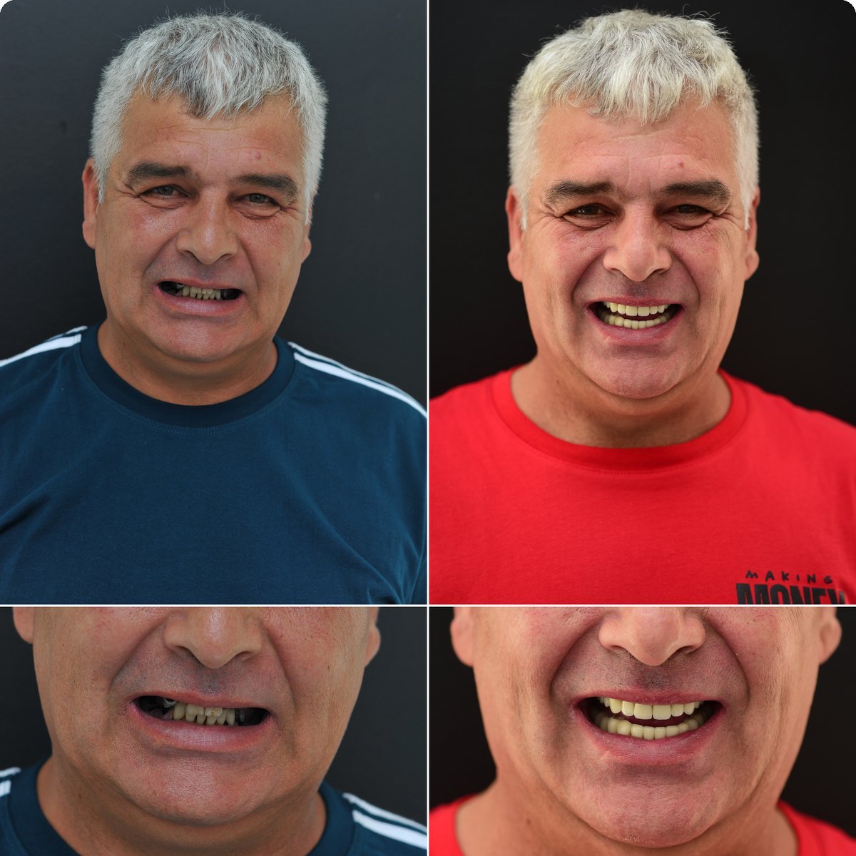 Caz 09, reabilitare orală pe implanturi la Radent Estetique Arad, înainte și după